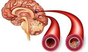 Ишемия сосудов головного мозга: признаки, диагностика, лечение