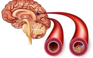 Ишемия сосудов головного мозга: признаки, диагностика, лечение