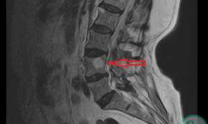 Гемангиома в теле позвонка: загадка, которую стоит раскрыть