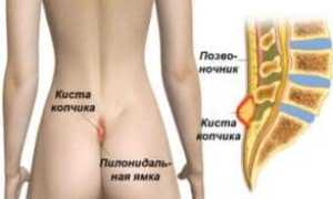 Киста копчика ее симптомы и лечение без операции