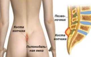 Киста копчика ее симптомы и лечение без операции