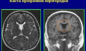 Киста прозрачной перегородки головного мозга