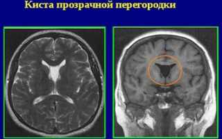 Киста прозрачной перегородки головного мозга