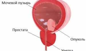 Симптомы и лечение кисты мочевого пузыря