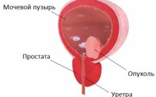 Симптомы и лечение кисты мочевого пузыря