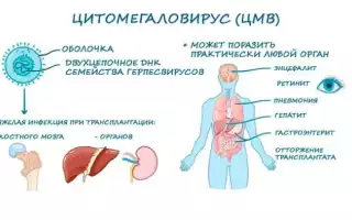 Цитомегалия: что это такое и как с этим бороться?