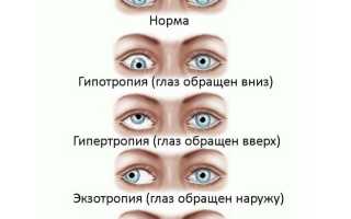 Расходящееся косоглазие: что это и как с этим справиться?