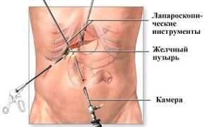 Проведение и подготовка к лапароскопической холецистэктомии