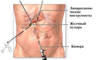 Проведение и подготовка к лапароскопической холецистэктомии