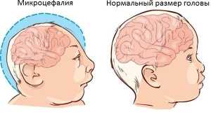 Микроцефалия головного мозга у ребенка