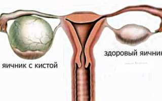 Насколько опасны функциональные кисты яичника