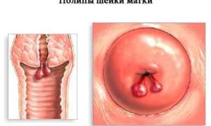 Лечение полипов шейки матки