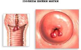 Лечение полипов шейки матки