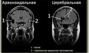 Симптомы арахноидальной кисты головного мозга и методы ее лечения