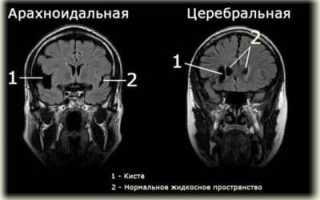 Симптомы арахноидальной кисты головного мозга и методы ее лечения