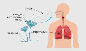 Аспергиллез: что это и как с ним бороться