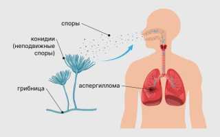 Аспергиллез: что это и как с ним бороться