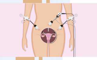 Характер менструации после лапароскопической операции