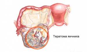 Тератома яичника на УЗИ: что это такое и как с этим справиться?