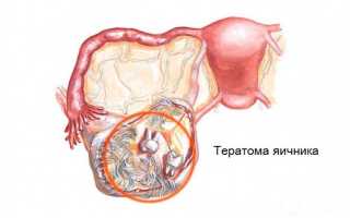 Тератома яичника на УЗИ: что это такое и как с этим справиться?