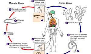 Что такое филярия: все, что вам нужно знать о редкой и опасной болезни