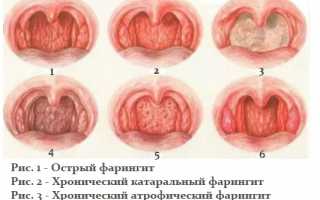Гнойный фарингит — причины, симптомы и лечение