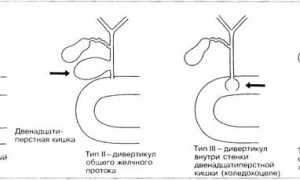 Симптомы и лечение кисты холедоха у детей