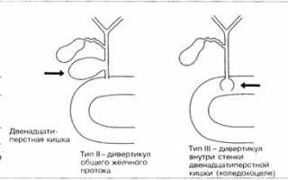 Симптомы и лечение кисты холедоха у детей