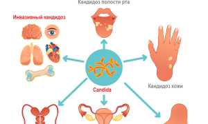 Инвазивный кандидоз: что это такое и как его распознать?