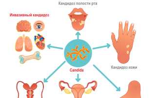 Инвазивный кандидоз: что это такое и как его распознать?