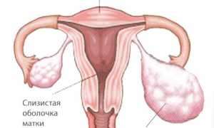 Кистома яичников больших размеров и необходимость операции