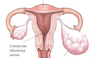Кистома яичников больших размеров и необходимость операции