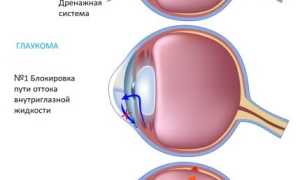 Вторичная глаукома: что это такое и как с ней справиться