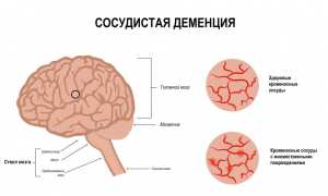 Смешанная корковая и подкорковая сосудистая деменция: что это и как с этим бороться?