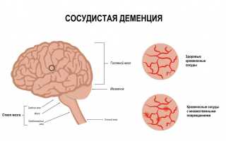 Смешанная корковая и подкорковая сосудистая деменция: что это и как с этим бороться?