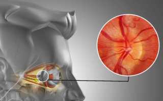 Ретробульбарный неврит: симптомы и лечение воспаления глазного нерва