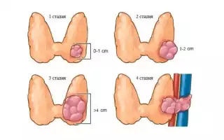 Фолликулярный рак щитовидной железы: всё, что нужно знать об этом заболевании