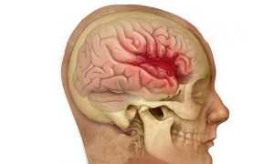 Признаки и последствия обширного кровоизлияния в мозг