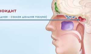 Все о кисте клиновидной пазухи