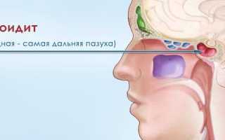 Все о кисте клиновидной пазухи