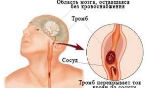 Причины нарушения мозгового кровообращения