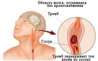 Причины нарушения мозгового кровообращения