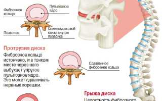 Лечение грыжи позвоночника — методы и результаты