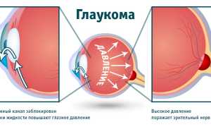 Остроугольная глаукома: что это такое и как с ней справиться