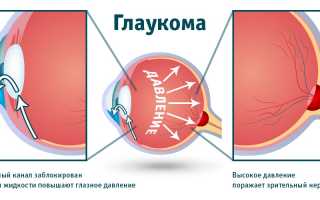 Остроугольная глаукома: что это такое и как с ней справиться