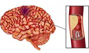 Ишемический инфаркт головного мозга