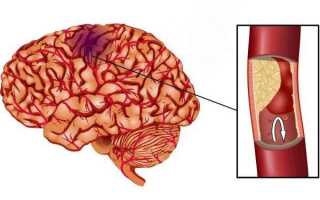 Ишемический инфаркт головного мозга